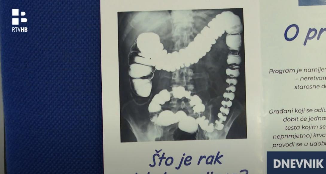 rak debelog crijeva.png